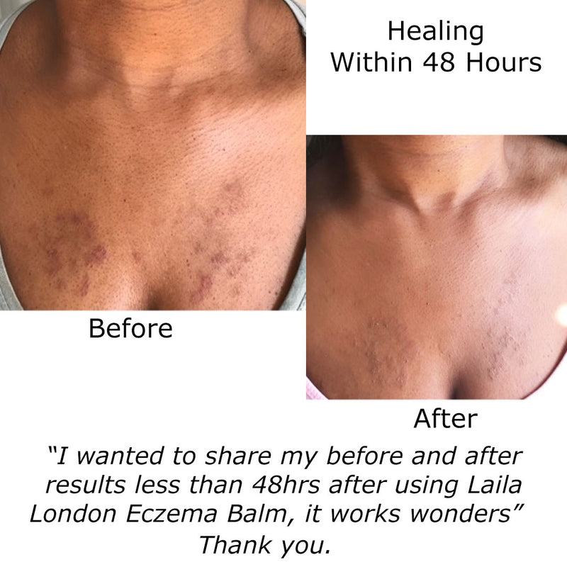 Psoriasis and Eczema Body Balm 100% Natural and Organic